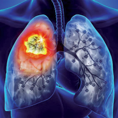 Rencontre scientifique autour du cancer du poumon